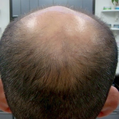 AGA治療後